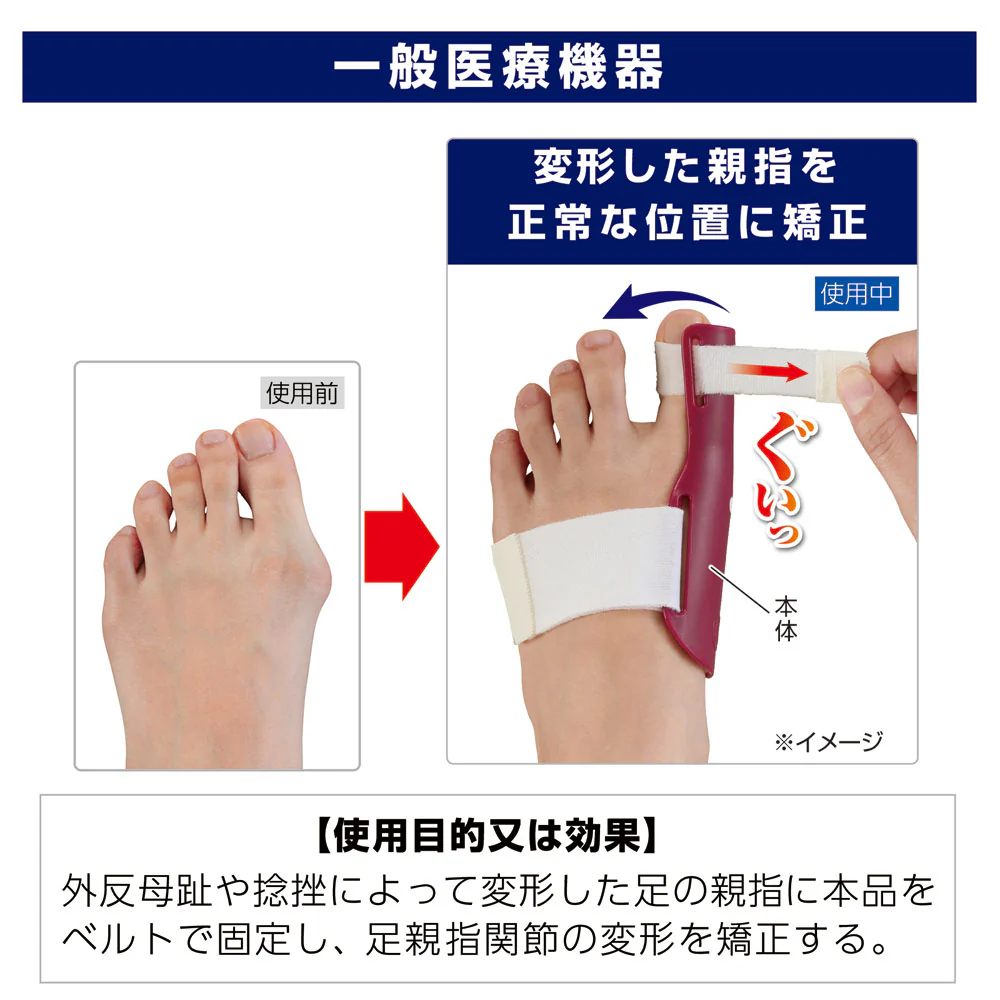 【一般医療機器】サイプラス プラスウォーク 外反母趾矯正プロテクター 左足用 1個 - Image 3